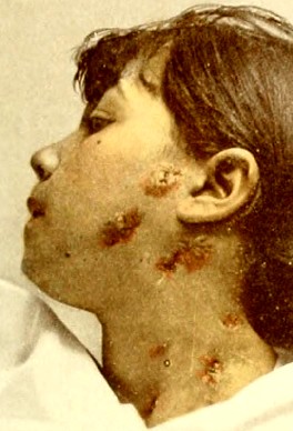 Syphilitic Nodules